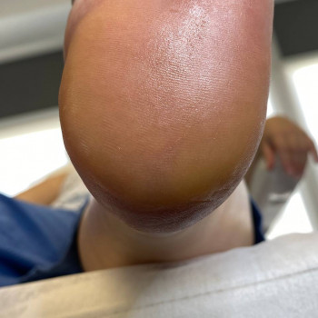 Обробка тріщин
                    Центры подологии Твоя стопа Львов