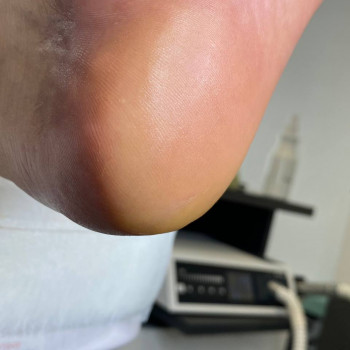 Обробка тріщин
                    Центры подологии Твоя стопа Львов