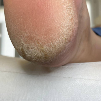 Обробка тріщин
                    Центры подологии Твоя стопа Львов