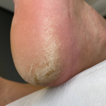 Обробка тріщин
                    Центры подологии Твоя стопа Львов