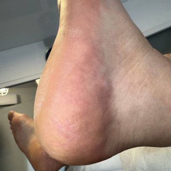 Обробка тріщин
                    Центры подологии Твоя стопа Львов