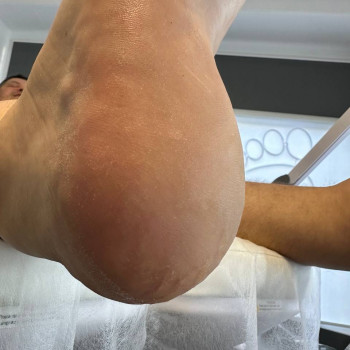 Обробка тріщин
                    Центры подологии Твоя стопа Львов