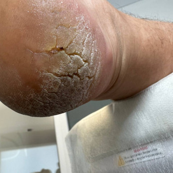 Обробка тріщин
                    Центры подологии Твоя стопа Львов