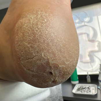 Обробка тріщин
                    Центры подологии Твоя стопа Львов