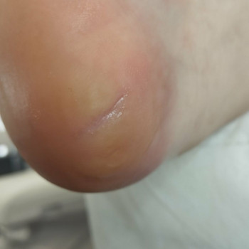 Обробка тріщин
                    Центры подологии Твоя стопа Львов