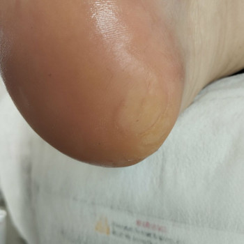 Обробка тріщин
                    Центры подологии Твоя стопа Львов