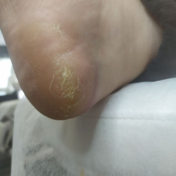 Обробка тріщин
                    Центры подологии Твоя стопа Львов