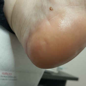 Обробка тріщин
                    Центры подологии Твоя стопа Львов