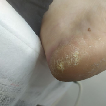 Обробка тріщин
                    Центры подологии Твоя стопа Львов