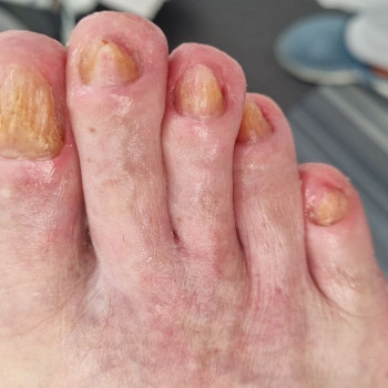 Обробка оніхогрифозних нігтів
                    Центры подологии Твоя стопа Львов