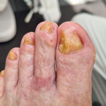 Обробка оніхогрифозних нігтів
                    Центры подологии Твоя стопа Львов