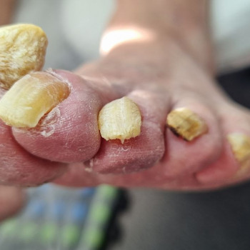 Обробка оніхогрифозних нігтів
                    Центры подологии Твоя стопа Львов