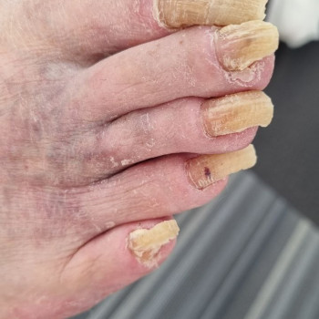 Обробка оніхогрифозних нігтів
                    Центры подологии Твоя стопа Львов