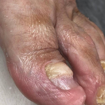 Обробка оніхогрифозних нігтів
                    Центры подологии Твоя стопа Львов