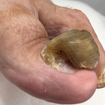 Обробка оніхогрифозних нігтів
                    Центры подологии Твоя стопа Львов