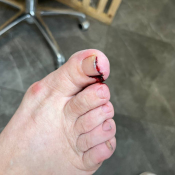 Корекція врослого нігтя
                    Центры подологии Твоя стопа Львов