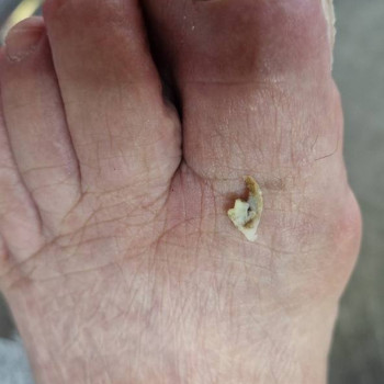 Корекція врослого нігтя
                    Центры подологии Твоя стопа Львов