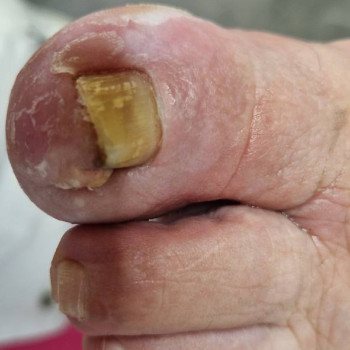 Корекція врослого нігтя
                    Центры подологии Твоя стопа Львов