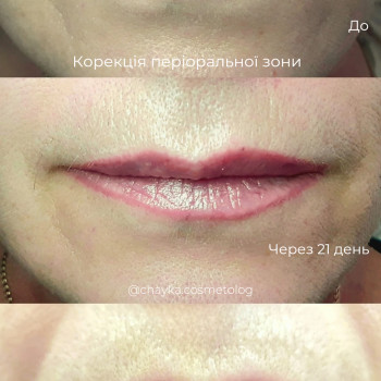 Контурна пластика губ
 