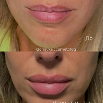 Контурна пластика губ
 