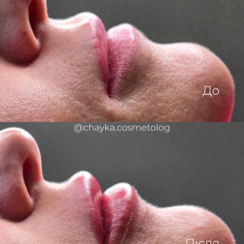 Контурна пластика губ
 