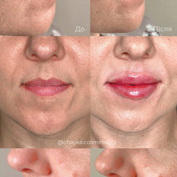 Контурна пластика губ
 