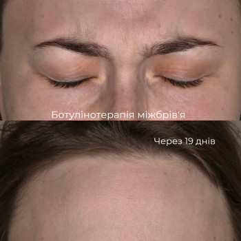 Ботулінотерапія
 