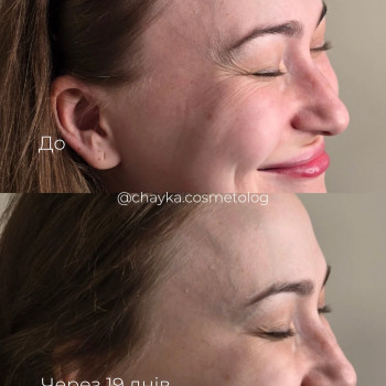 Ботулінотерапія
 