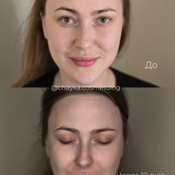 Ботулінотерапія
 