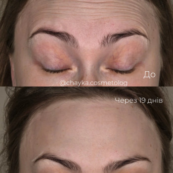 Ботулінотерапія
 