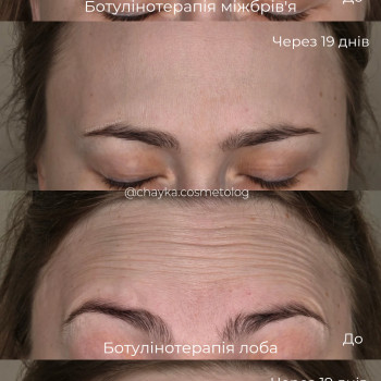 Ботулінотерапія
 