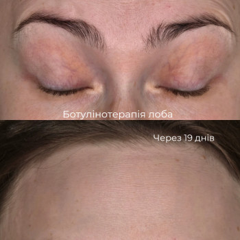 Ботулінотерапія
 