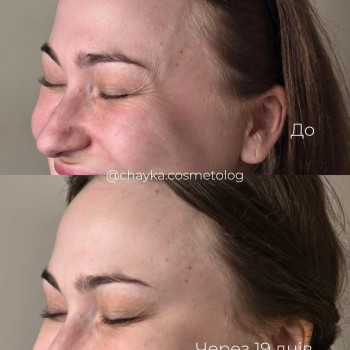 Ботулінотерапія
 
 