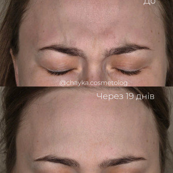 Ботулінотерапія
 
 