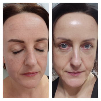 До та після серединного пілінгу