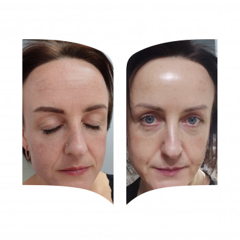 Поверхневі та серединні пілінги
                    Косметолог Інга Хмельницький