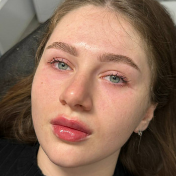 Контурна пластика губ
                    Врач-косметолог Юлия Киев