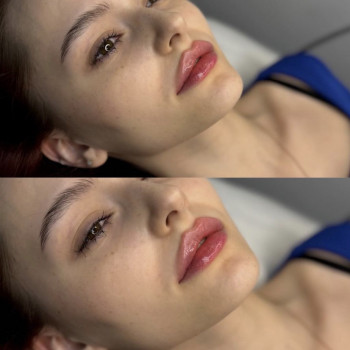 Збільшення губ
                    Косметолог Анастасия Київ