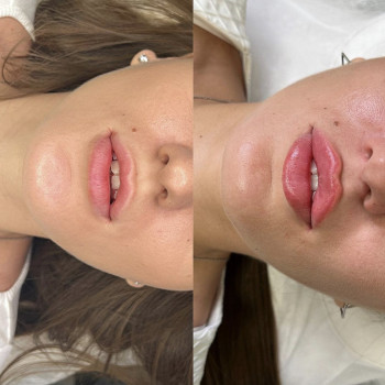 Збільшення губ
                    Косметолог Анастасия Київ