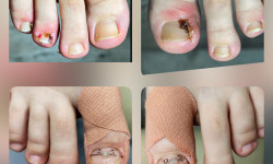 Врослий ніготь Подолог Андрей Одеса