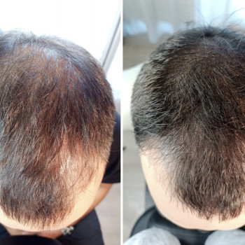 Тртхопігментпція та загущення волосся для чоловіків