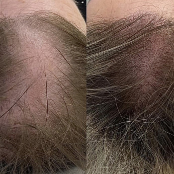 Трихопігментація та загущення волосся для жінок