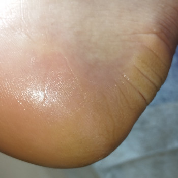 Педикюр
                    Подолог Евгения Киев