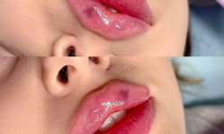 Контурна пластика губ Juvederm Smile 0.55 мл: ніжний об'єм і природний вигляд Косметологічний центр Центр лазерної косметології Луцьк