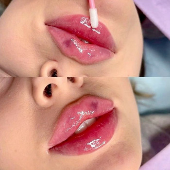 Контурна пластика губ філером Juvederm Ultra 3
                    Косметологічний центр Центр лазерної косметології Луцьк