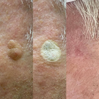 Кріодеструкція кератоми