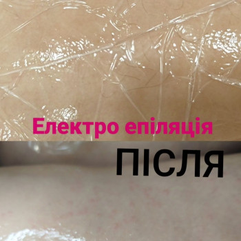 Електро епіляція
                    Мастер депиляции Аліна Каменское