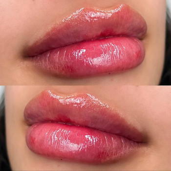 Контурна пластика губ філером Juvederm Ultra 3
                    Косметологічний центр Центр лазерної косметології Луцьк