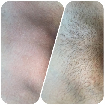 Глибоке бікіні      