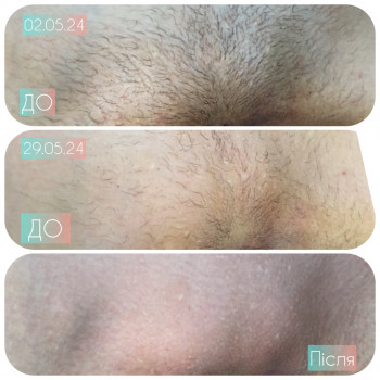 Глибоке бікіні результат
      